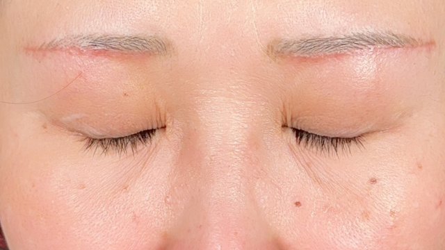 手术前的状态 其一