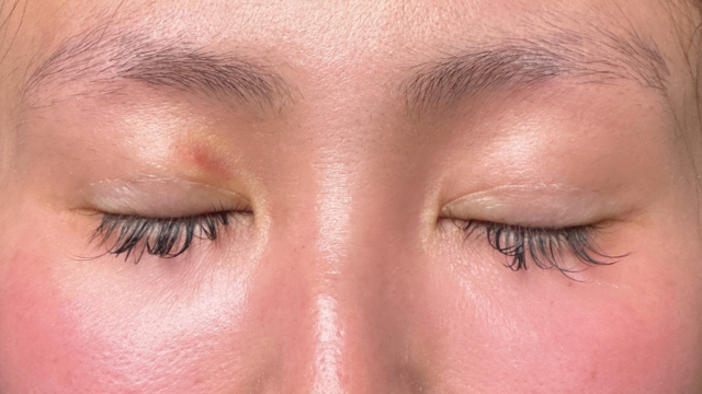 手術前の状態 その1