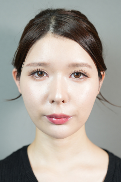 手術前の状態 その1