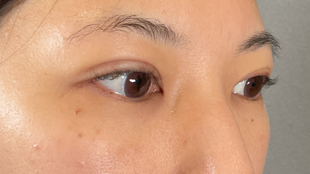 手術前の状態 その1