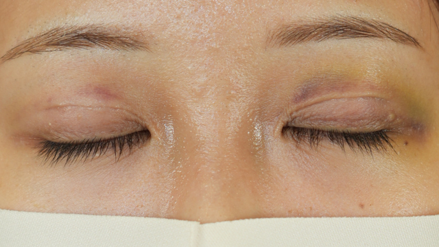 手術前の状態 その1