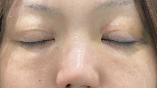 手術前の状態 その1