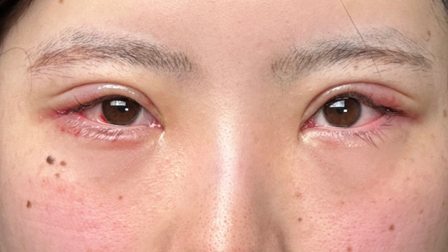 手術前の状態 その1