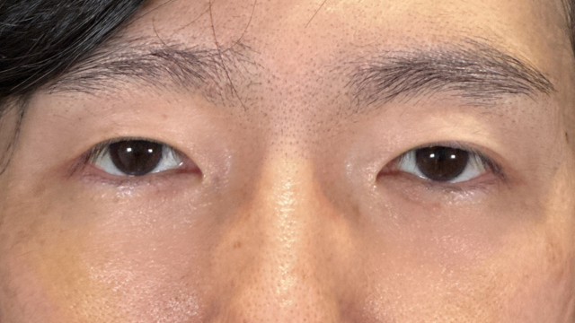 手术前的状态 其一