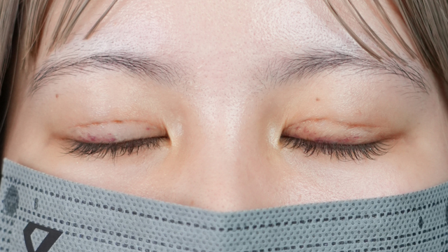 手術前の状態 その1