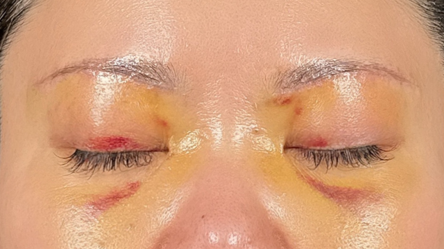 手术前的状态 其一