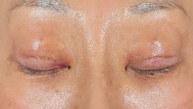 手術前の状態 その1