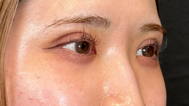 手術前の状態 その1