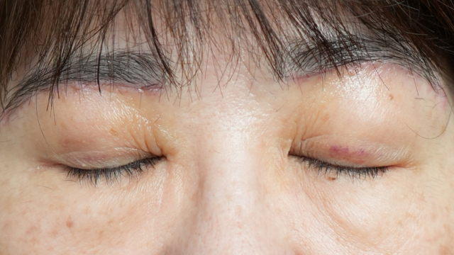 Postoperative Condition Part 1