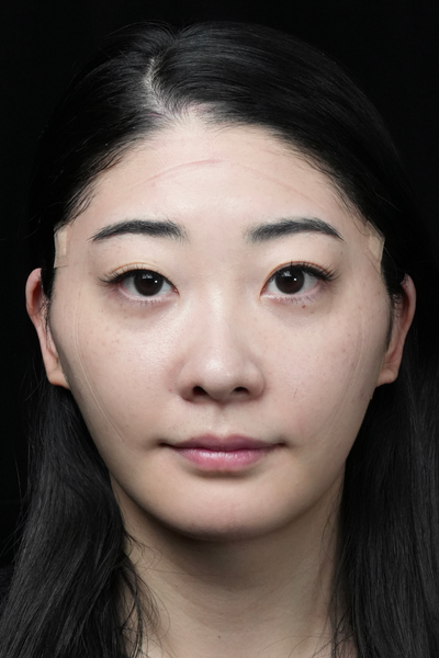 手术前的状态 其一