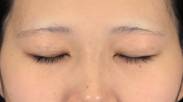 手術前の状態 その1