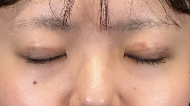 手術前の状態 その1