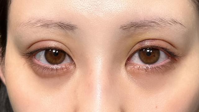 手术前的状态 其一