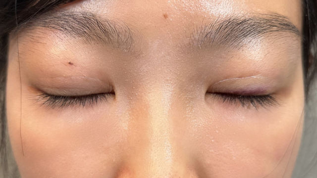 手术前的状态 其一