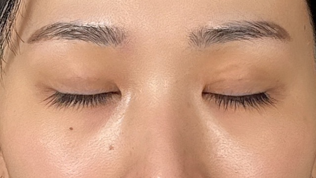 手術前の状態 その1