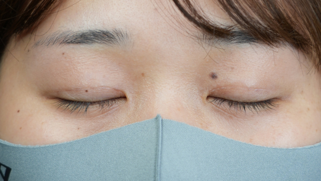 手術前の状態 その1