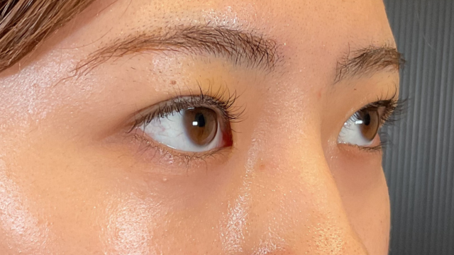 手術前の状態 その1