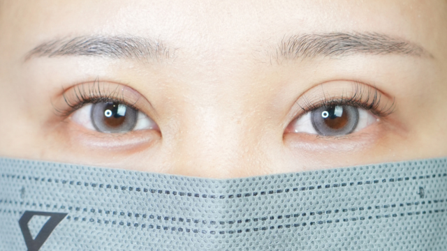 手術前の状態 その1