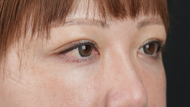 手术前的状态 其一