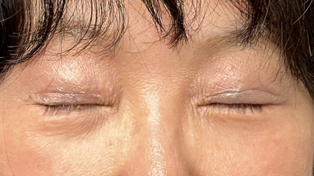 手術前の状態 その1