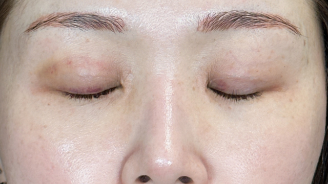 手術前の状態 その1