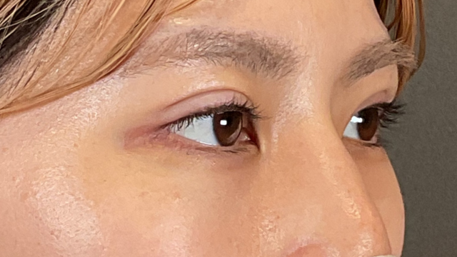 手術前の状態 その1