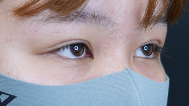 手术前的状态 其一