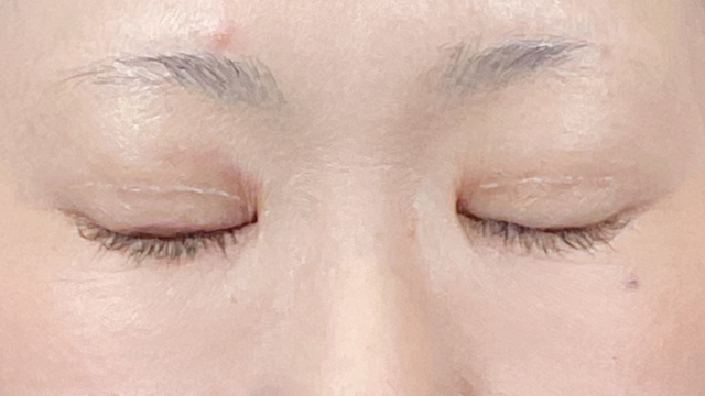 手术前的状态 其一