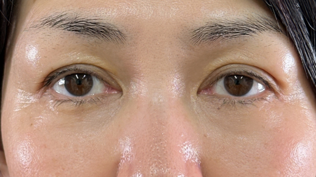 手术前的状态 其一