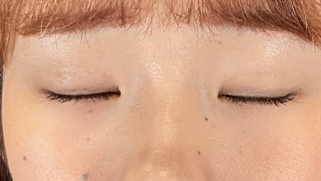 手术前的状态 其一