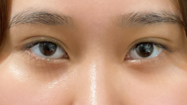 手術前の状態 その1