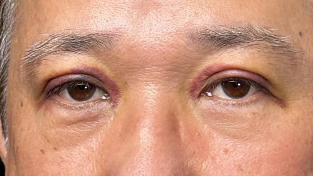 手术前的状态 其一