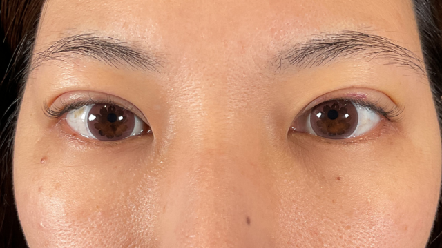 手術前の状態 その1