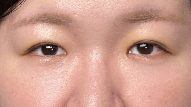 手术前的状态 其一