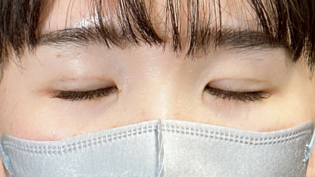 手術前の状態 その1