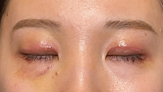 手術前の状態 その1