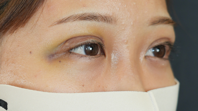 手術前の状態 その1