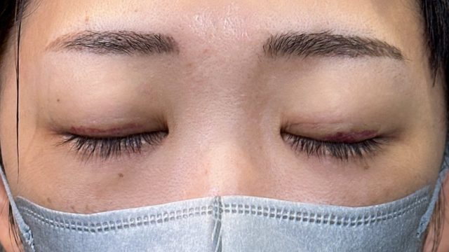 手術前の状態 その1