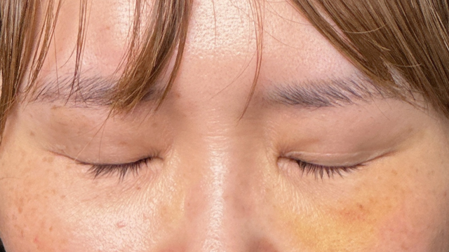 手術前の状態 その1