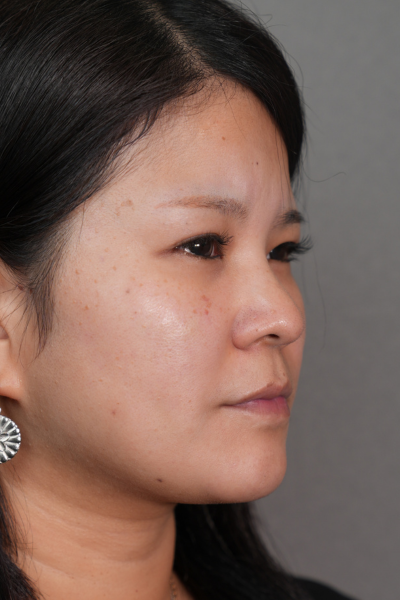 手術前の状態 その1