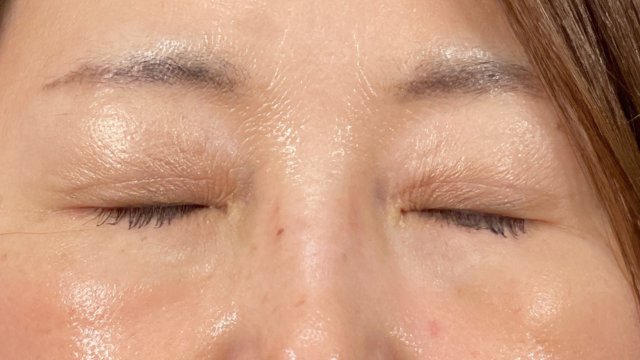 手术前的状态 其一