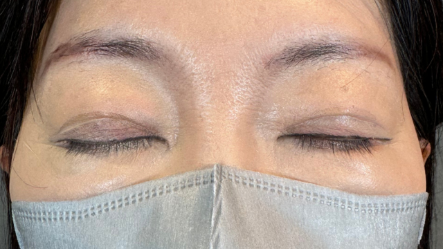 手術前の状態 その1