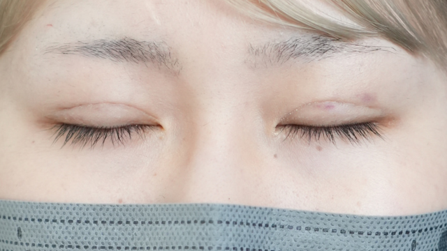 手术前的状态 其一