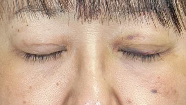 Postoperative Condition Part 1