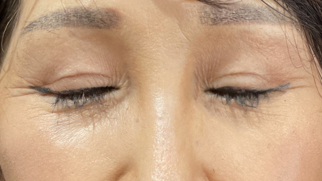 手术前的状态 其一