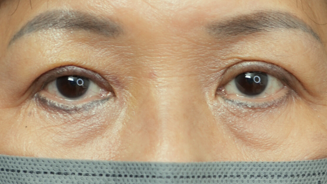 手术前的状态 其一