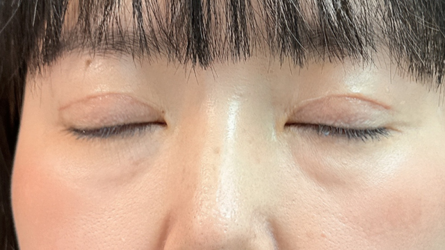 手術前の状態 その1