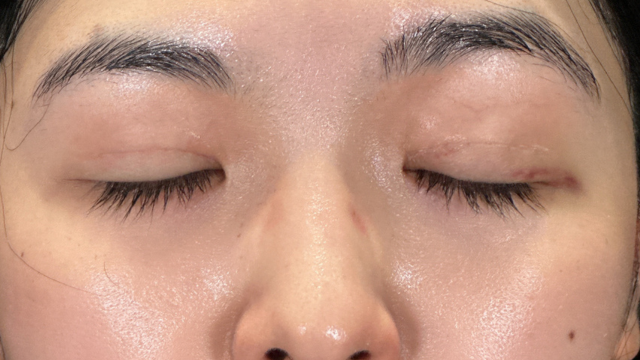 手术前的状态 其一