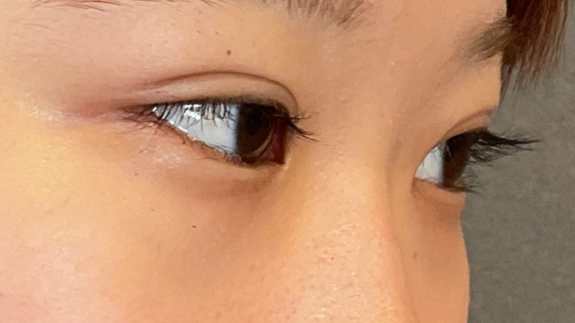 手術前の状態 その1