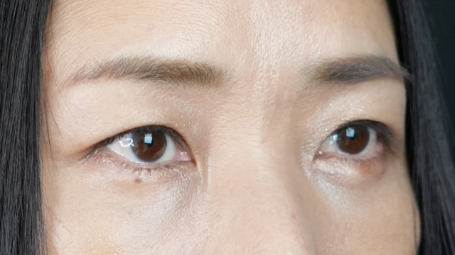 手術前の状態 その1